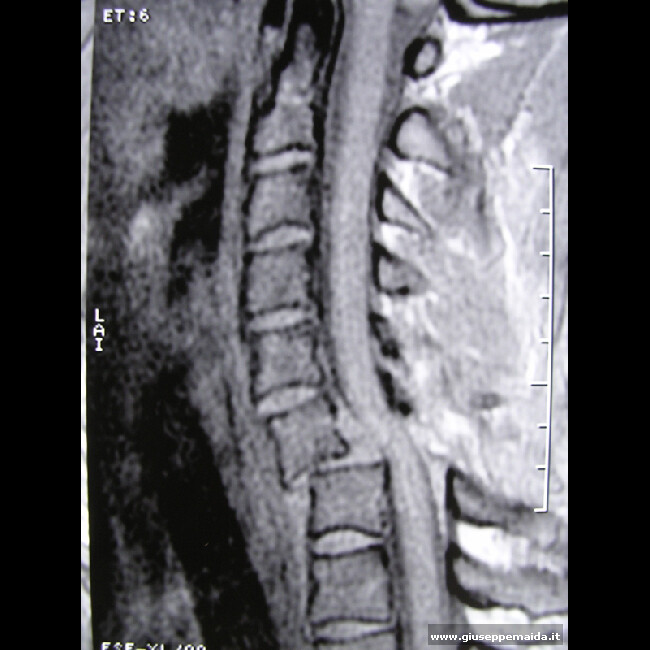 Traumi Vertebromidollari