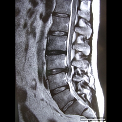 Pre-op:ernia discale e discopatia