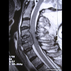 Caso1,Pre-op:il tumore hacompletamente stravolto la architettura vertebrale