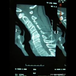 pre-op:si nota la deformità in cifosi del rachide cervicale