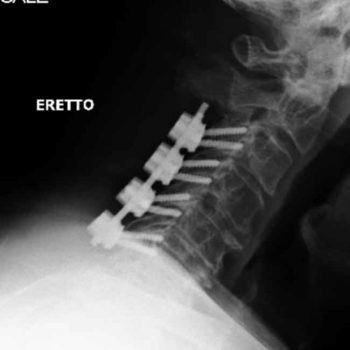 Caso 1b, post op: la radiografia mostra la stabilizzazione effettuata dopo la decompressione posteriore, mediante viti nelle masse laterali e barre in titanio