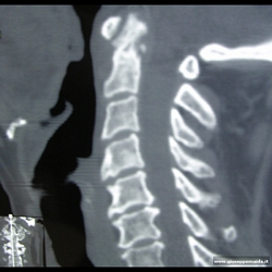 Pre-op:si evidenzia la deformità di C2 e la conseguente instabilità vertebrale